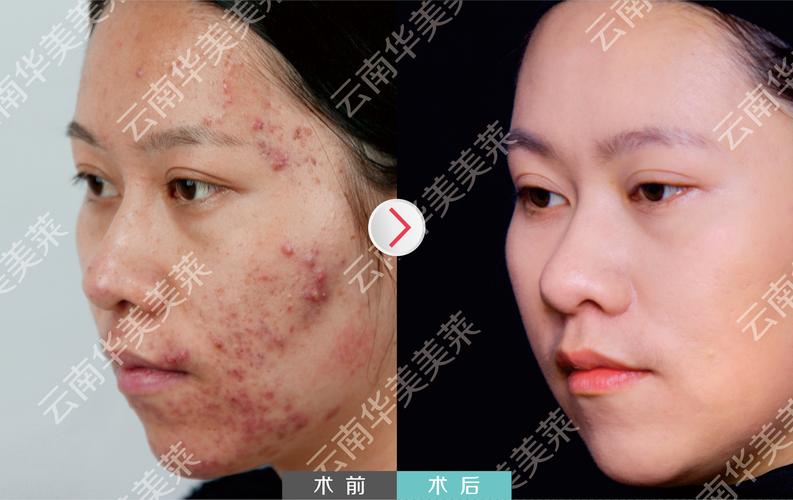 长沙红蓝光祛痘著美莱效果如何？-图2