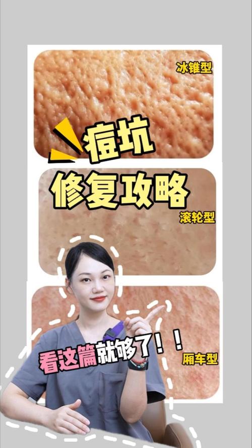 玻尿酸祛痘坑真的有效吗?-图3 玻尿酸祛痘坑真的有效吗?-图3