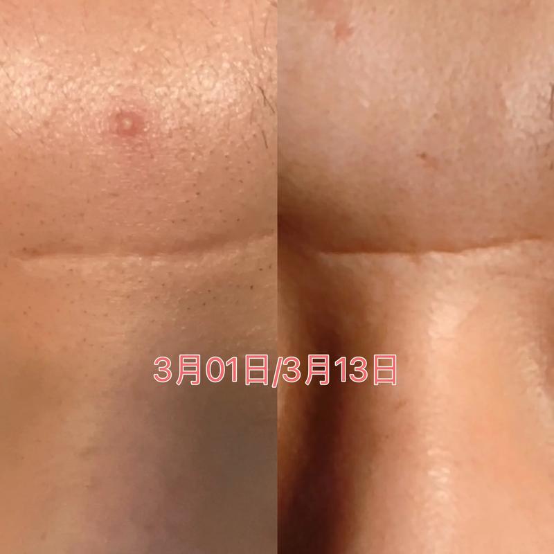 激光祛痘两次间隔多久合适？-图2