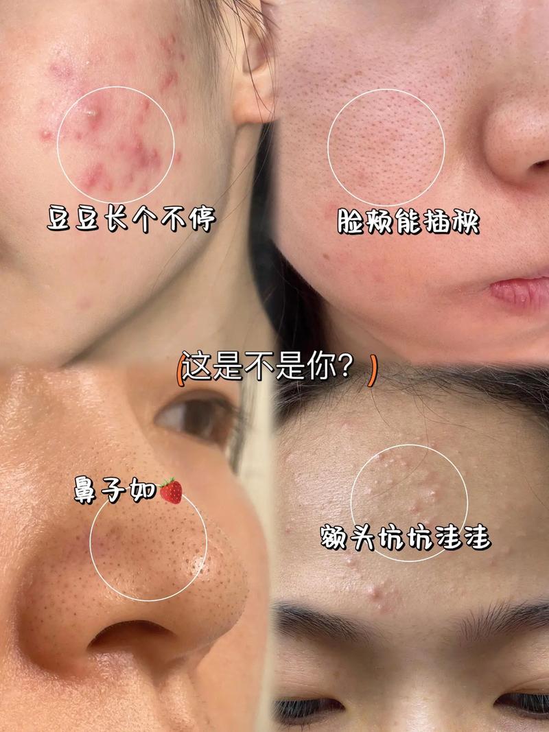 激光祛痘两次间隔多久合适？-图3