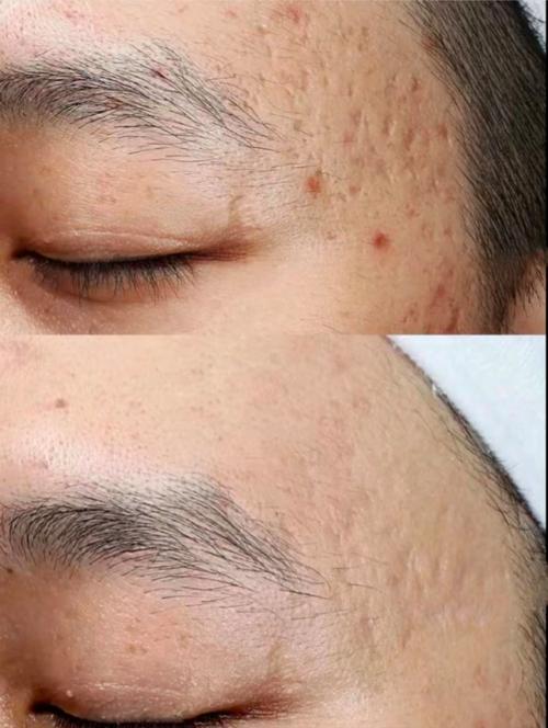 激光祛痘两次间隔多久合适？-图1