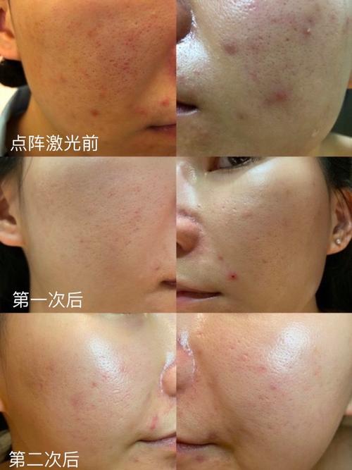 激光祛痘多久见效？-图3