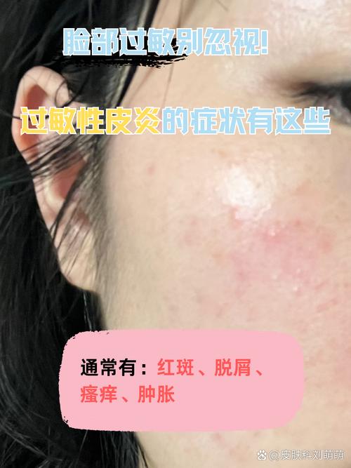 护肤品过敏有哪些症状？-图3