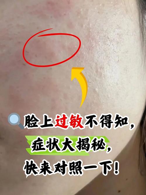 护肤品过敏有哪些症状？-图2