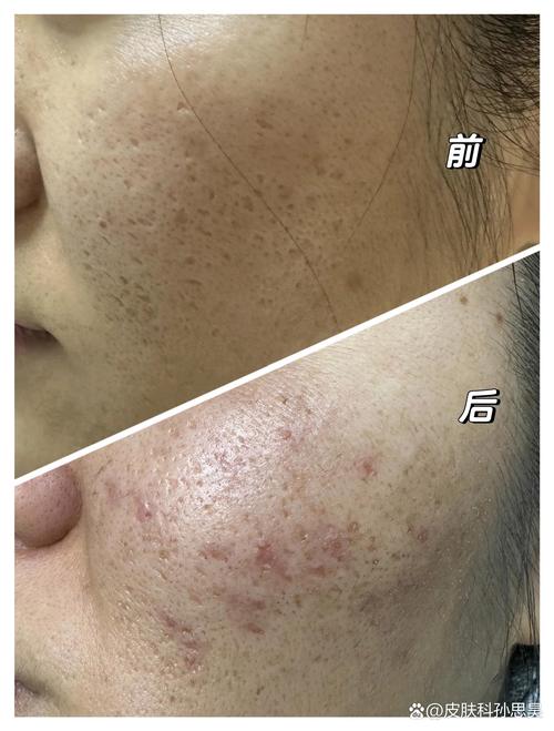 激光祛痘印手术靠谱吗？-图2