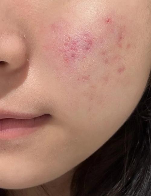 光子嫩肤祛痘印会复发吗？-图2