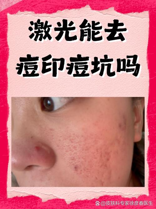 光子嫩肤祛痘印会复发吗？-图1