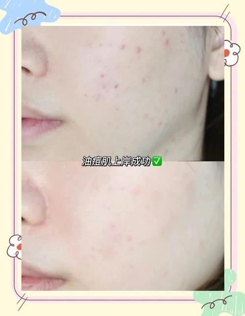 早晨敷祛痘面膜合适吗？-图3