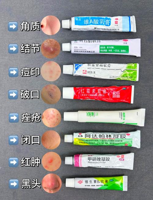 洋甘菊祛痘消炎药膏真的有效吗？-图3