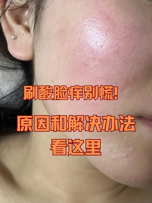 祛痘产品致脸脱皮刺痛咋办？-图1