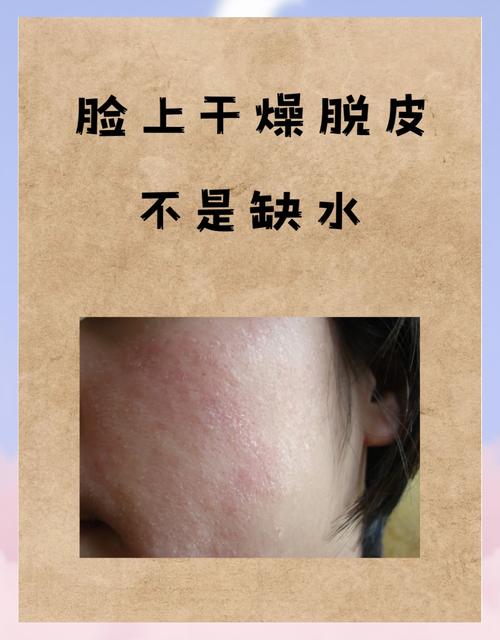 祛痘产品致脸脱皮刺痛咋办？-图3