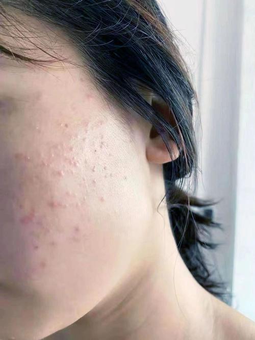 祛痘产品致脸脱皮刺痛咋办？-图2