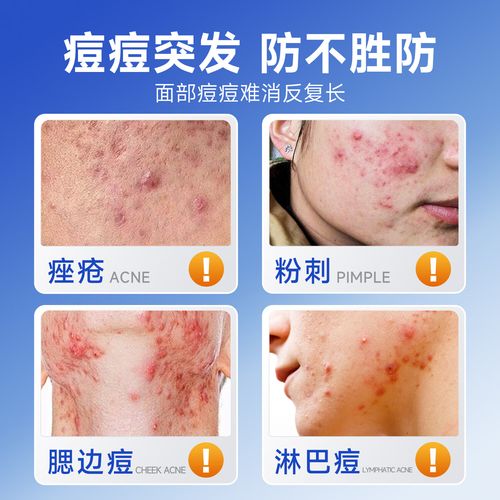 香港祛痘药膏有哪些？推荐哪种？-图3