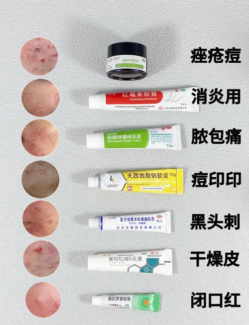 脸上有痘痘，护肤品该怎么选？-图1