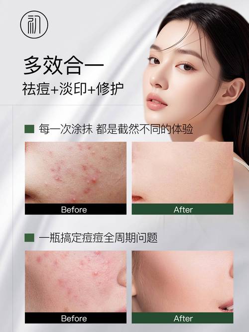 真正有用的祛痘印产品,到底该怎么选?-图3 真正有用的祛痘印产品,到底该怎么选?-图3