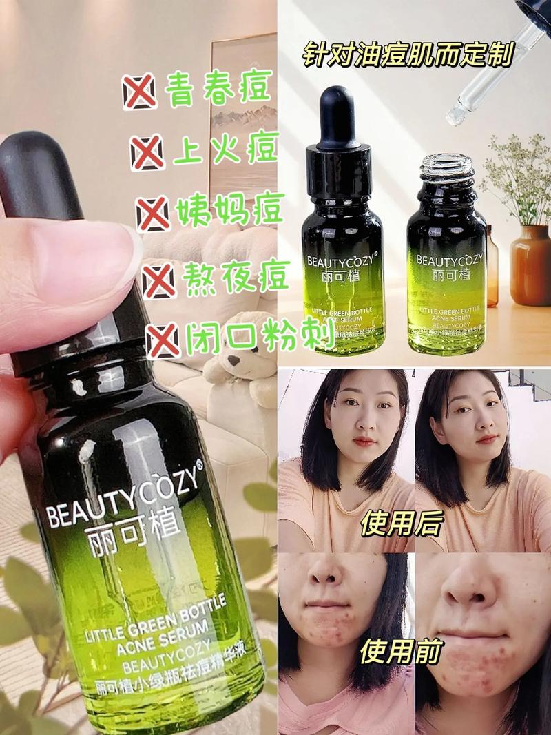 祛痘印选什么植物？哪种最有效？-图2