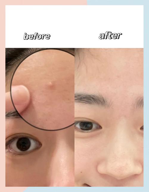 狮王祛痘膏后能直接化妆吗？-图1