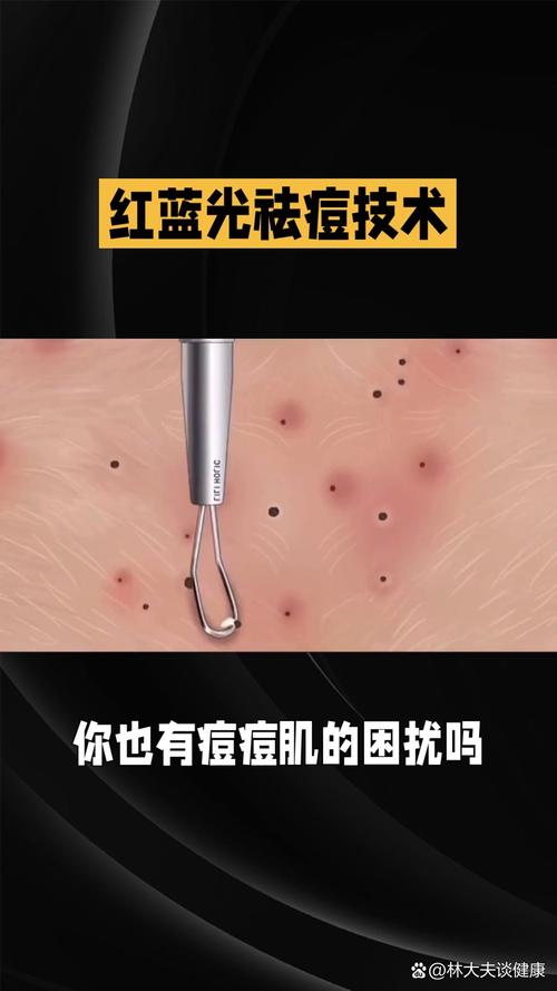 红蓝光祛痘能天天照吗？-图1