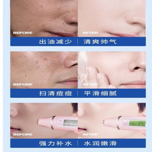 男士祛痘印爽肤水真的有效吗？-图1