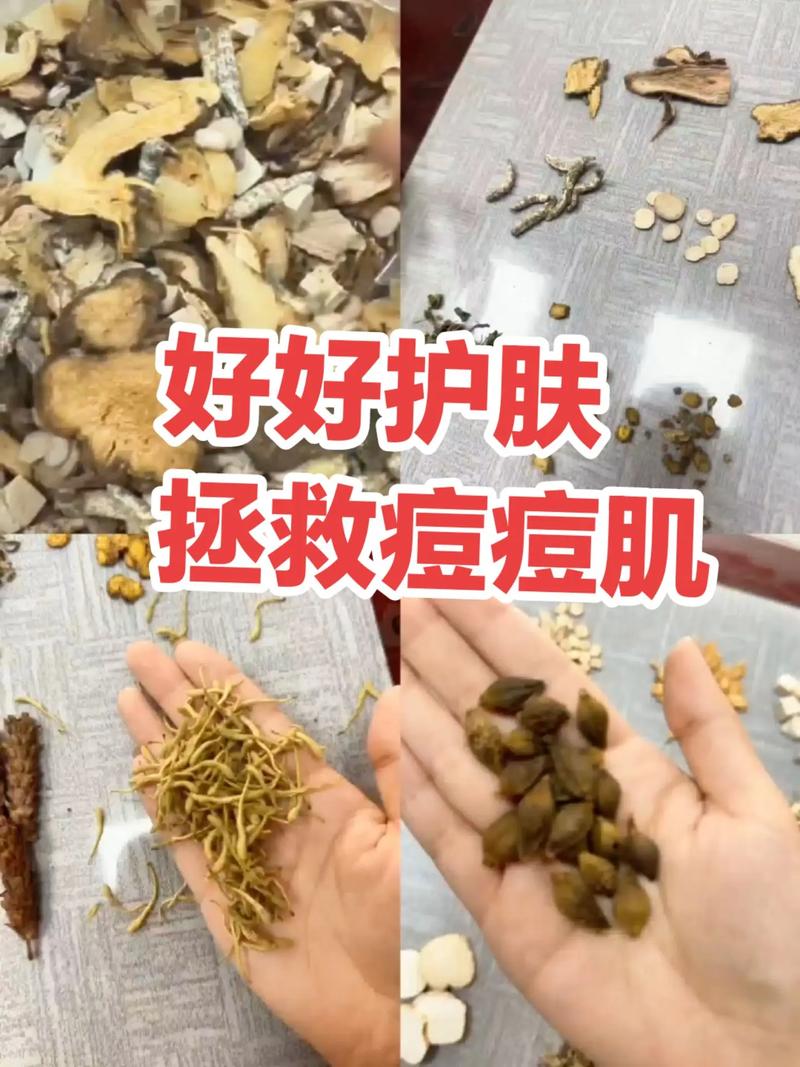 如何自制祛青春痘面膜-图2