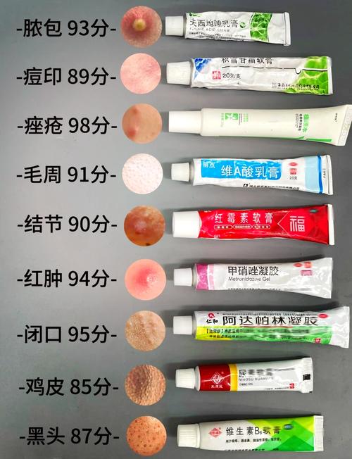 祛痘膏激素有什么害处-图1