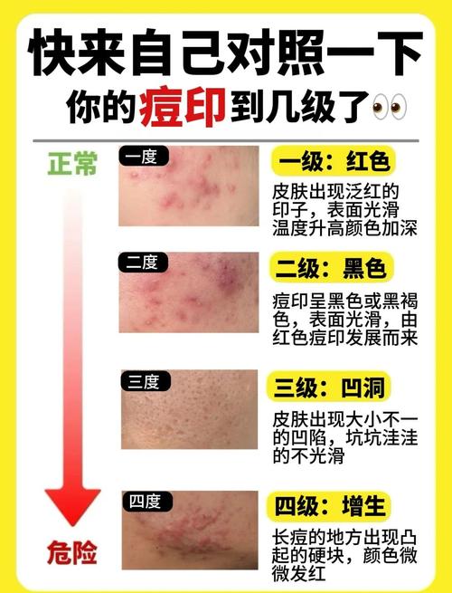 祛痘方法有哪些？哪种最有效？-图3