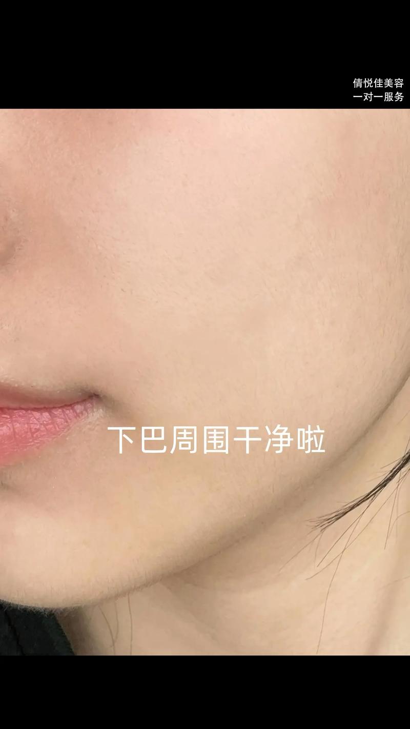 祛痘疤痕什么有效果吗-图2