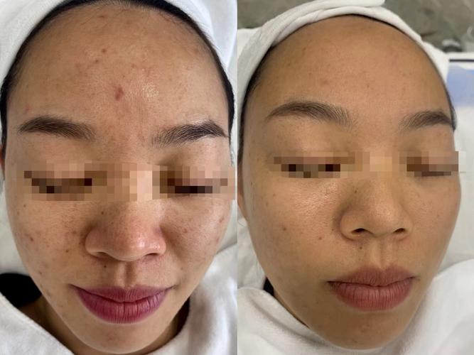 绿豆粉加白芷祛痘效果-图3