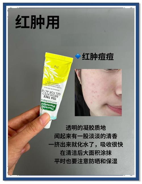 姜片和土豆祛痘那个好-图2