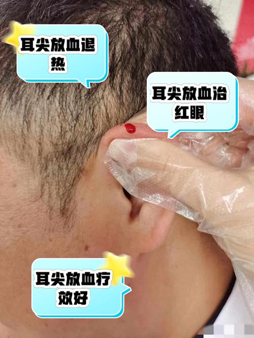 耳朵上放血祛痘的原理-图1