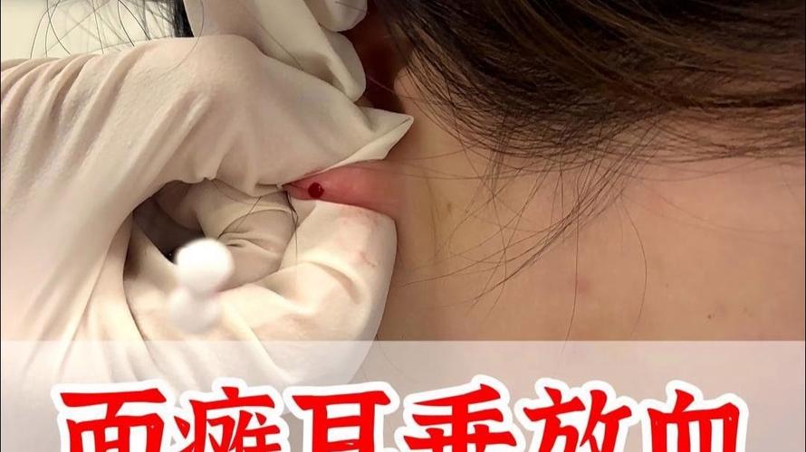 耳朵上放血祛痘的原理-图3