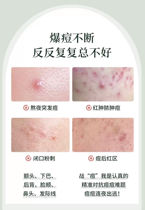 闭合性粉刺用护肤品吗-图2