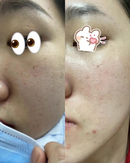 激光和点阵那个祛痘印-图1