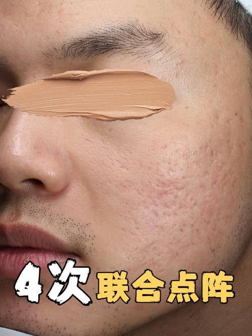 激光祛痘印，到底何时做最好？-图1