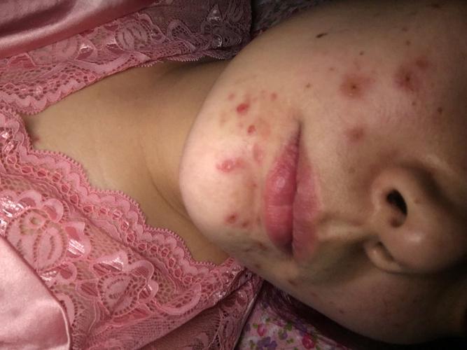 祛痘产品致痘起泡，是过敏还是刺激？-图1