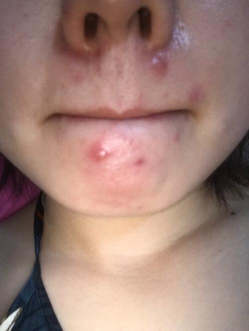 祛痘产品致痘起泡，是过敏还是刺激？-图3