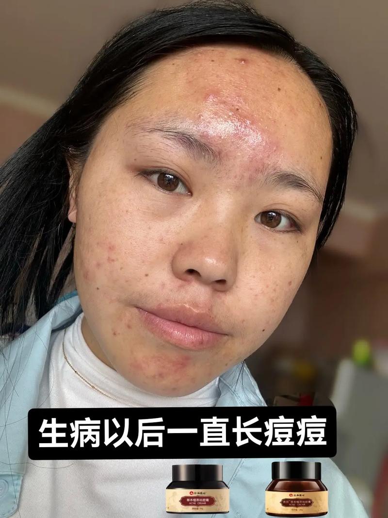 用祛痘产品的时候刺痛-图3