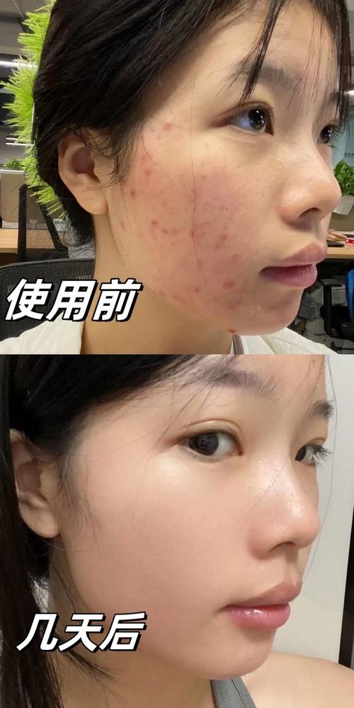 祛痘霜后能立即化妆吗？-图2