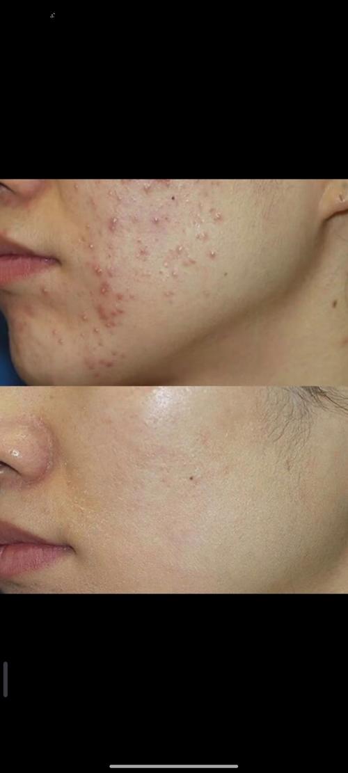 粉刺针消毒就能祛痘？靠谱吗？-图3