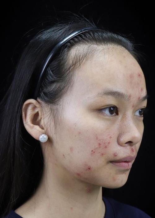 祛痘期间可以染头发吗-图1