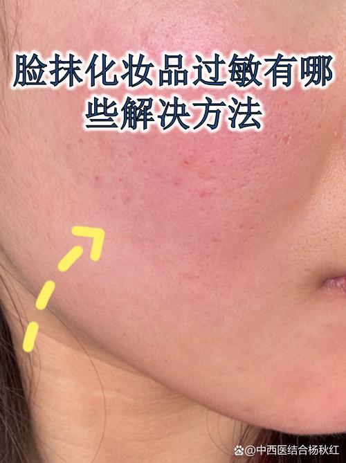 脸过敏了还能用护肤品吗？-图3