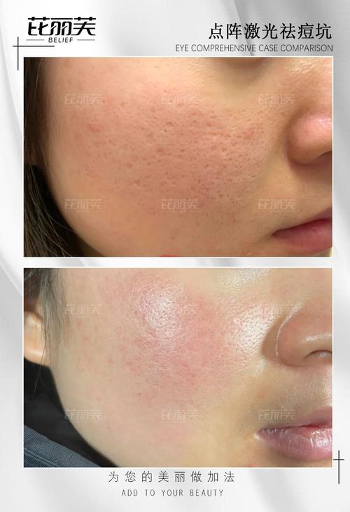镭射磨皮 激光祛痘坑-图2