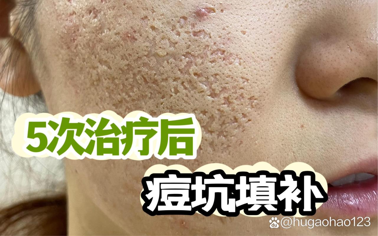 镭射磨皮 激光祛痘坑-图3