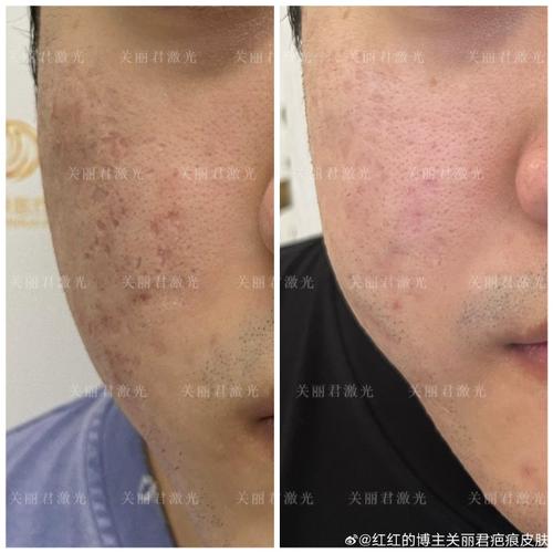 医院都能做激光祛痘吗？-图1