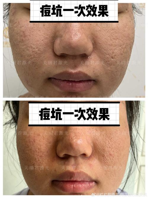 医院都能做激光祛痘吗？-图2