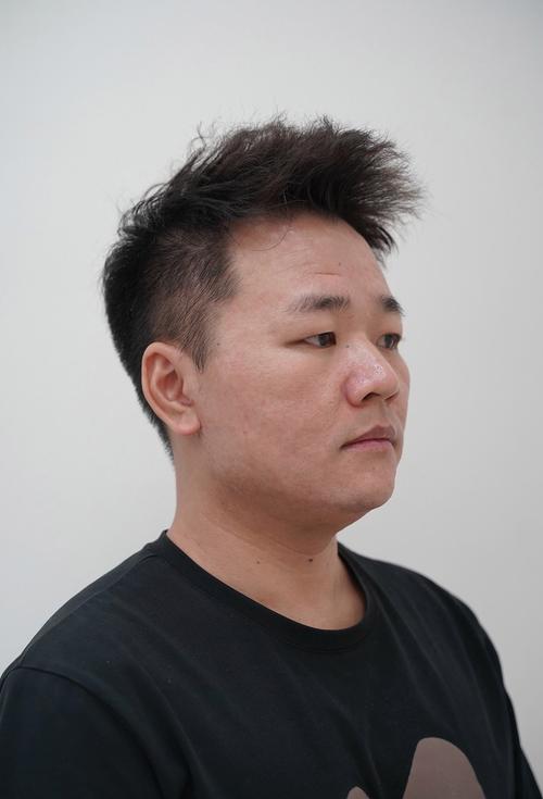 医院都能做激光祛痘吗？-图3