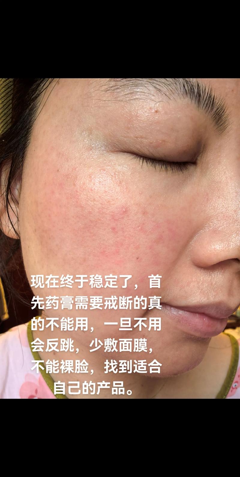 激光祛痘后出血怎么办？-图3