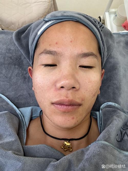 蓝光红光祛痘后真的会结痂吗？-图1