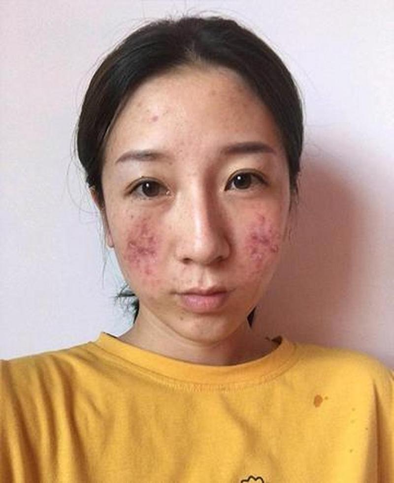 蓝光红光祛痘后真的会结痂吗？-图2