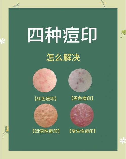 顽固痘印多年难消，如何有效去除？-图2